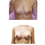 breast-aug-ba-7