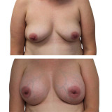 breast-aug-ba-4