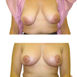 breast-lift-ba-1