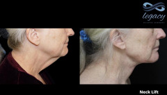 face-neck-ba-2