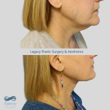 face-neck-ba-11