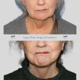 face-neck-ba-5