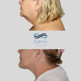 facetite-ba-3